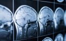Crean herramienta con IA para un diagnóstico temprano del alzhéimer a través del sueño