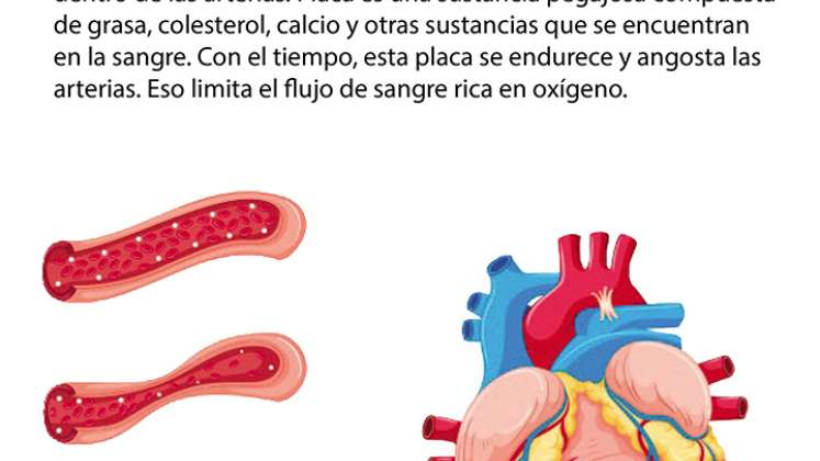 Arterioesclerosis