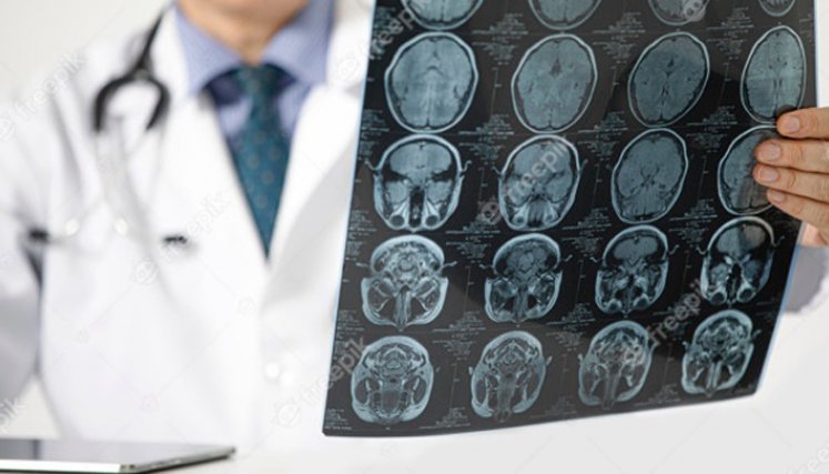A medida que avanza la pandemia en el mundo, las investigaciones científicas encuentran nuevas marcas que deja la enfermedad, como lo son las afectaciones neurológicas. / Foto: Freepik