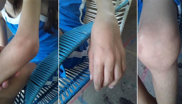 La artritis reumatoide es una enfermedad crónica que causa dolor en las articulaciones, rigidez, hinchazón y disminución del movimiento articular. / Foto: Cortesía