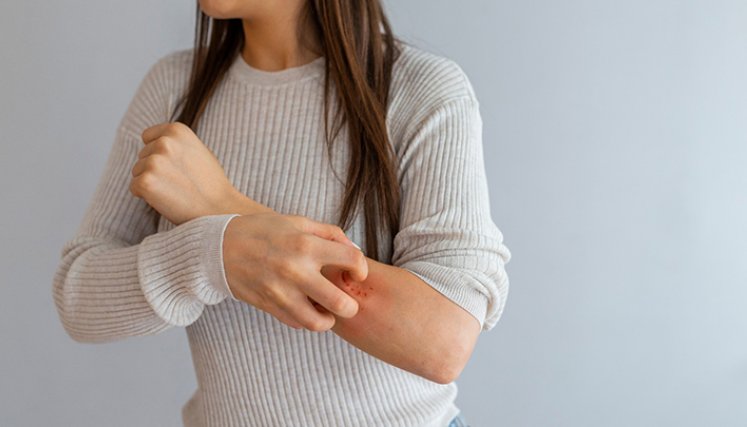 Dermatitis atópica