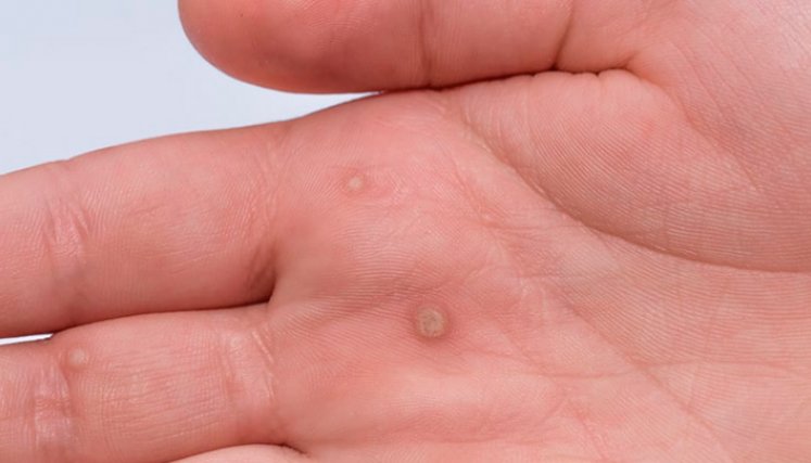Virus del Papiloma Humano (VPH) 