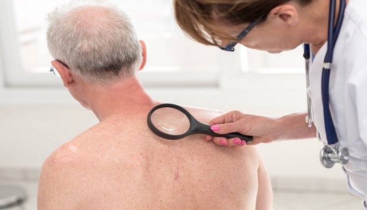 Melanomas. / Foto: Cortesía