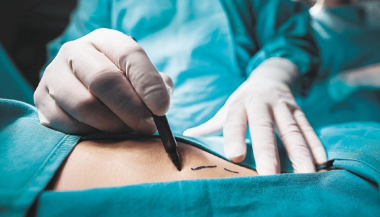 Más de 40 mujeres contrajeron una infección durante cirugía estética en Medellín. 