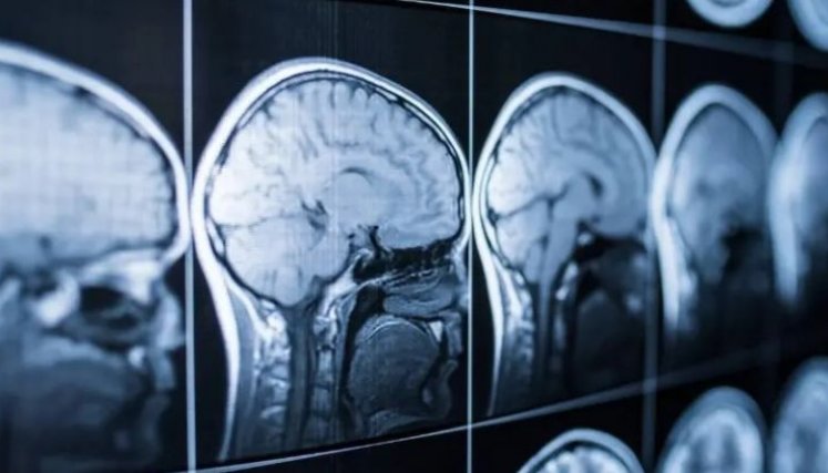 Crean herramienta con IA para un diagnóstico temprano del alzhéimer a través del sueño