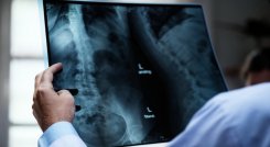 Osteoporosis