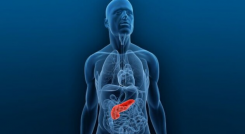 Cáncer de páncreas
