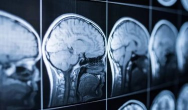 Crean herramienta con IA para un diagnóstico temprano del alzhéimer a través del sueño